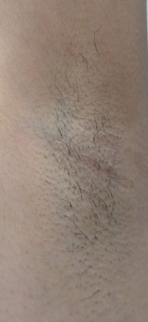 医療レーザー脱毛の1回目の施術から2ヶ月後の脇